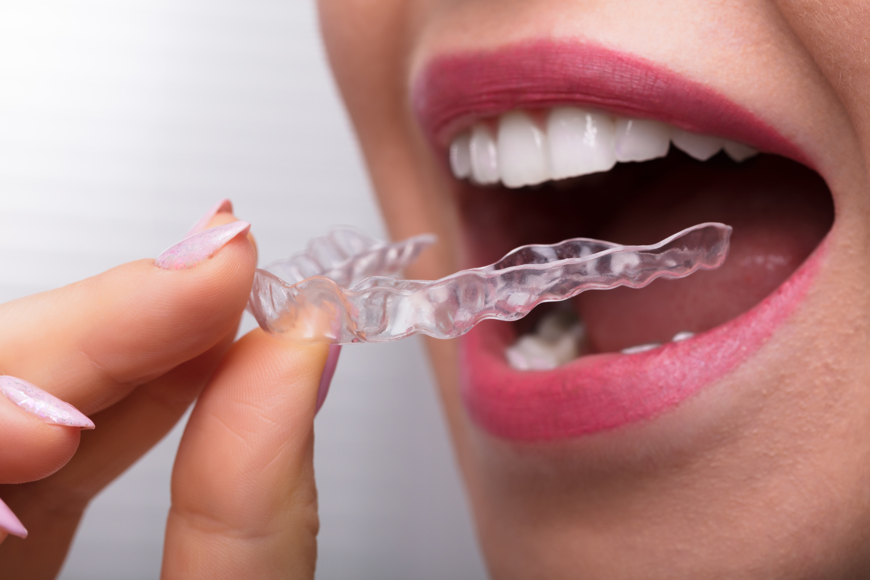 Woman Putting Transparent Aligner In Teeth
